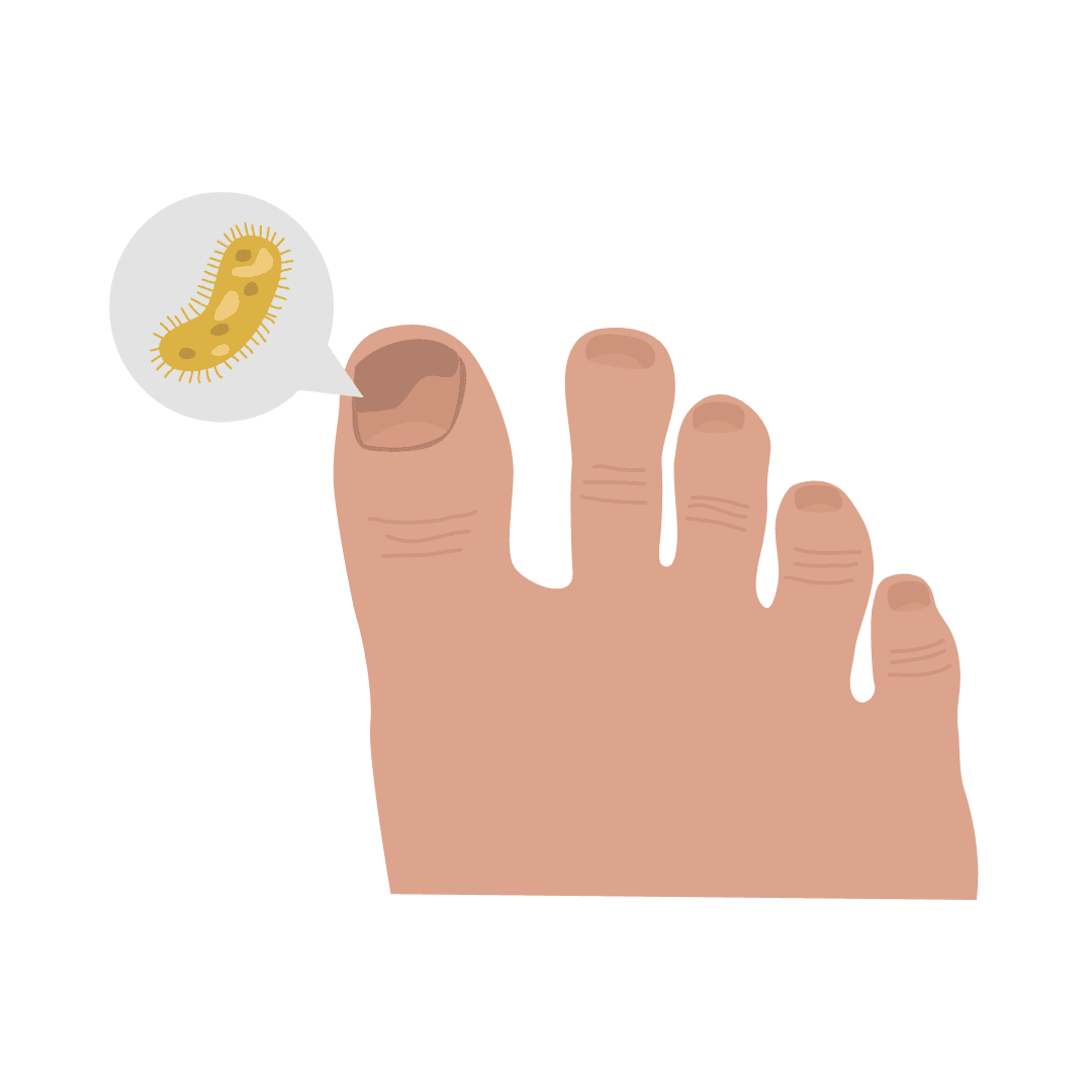 Champignons des ongles (onychomycose) et champignons des pieds (pied d'athlète)
