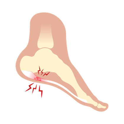Épine de Lenoir (ostéophyte)