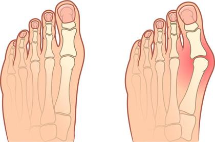 Hallux valgus (oignon)